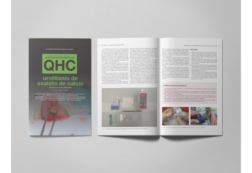 Revista QHC Urolitiasis de oxalato de calcio -Que Hacer Con...
